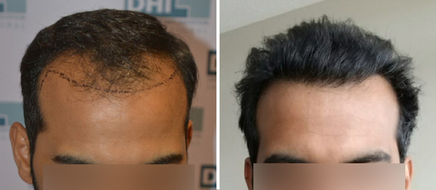 DHI before & after hair transplant results