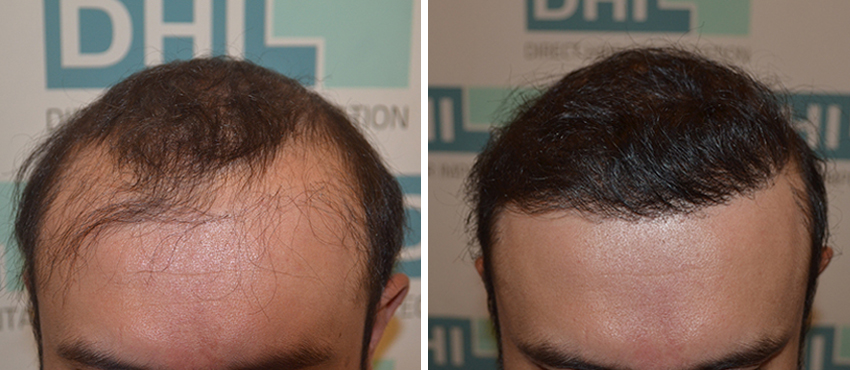 DHI before & after hair transplant results
