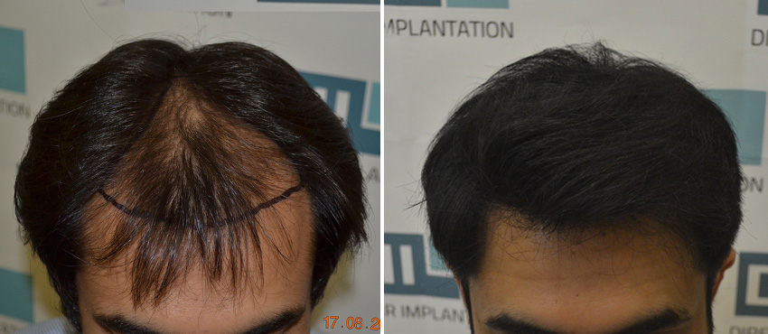 DHI before & after hair transplant results