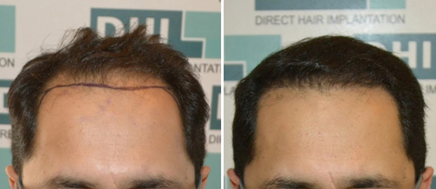 DHI before & after hair transplant results