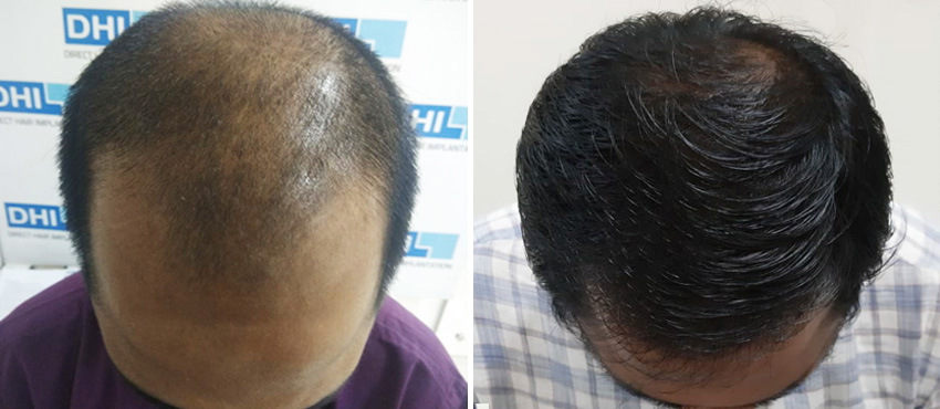 DHI before & after hair transplant results