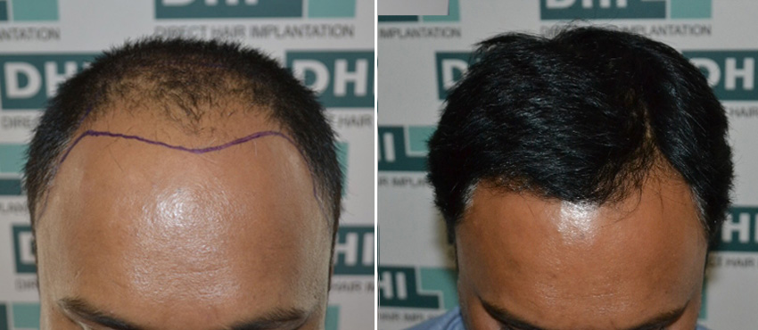 DHI before & after hair transplant results