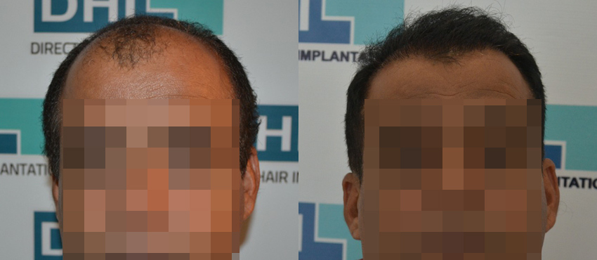 DHI before & after hair transplant results