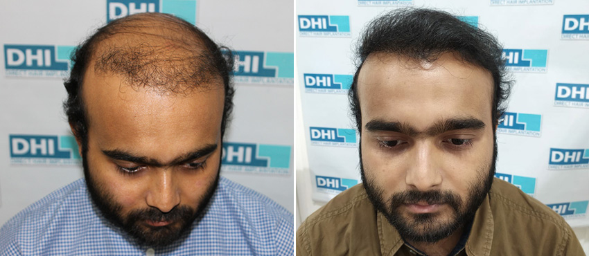 DHI before & after hair transplant results