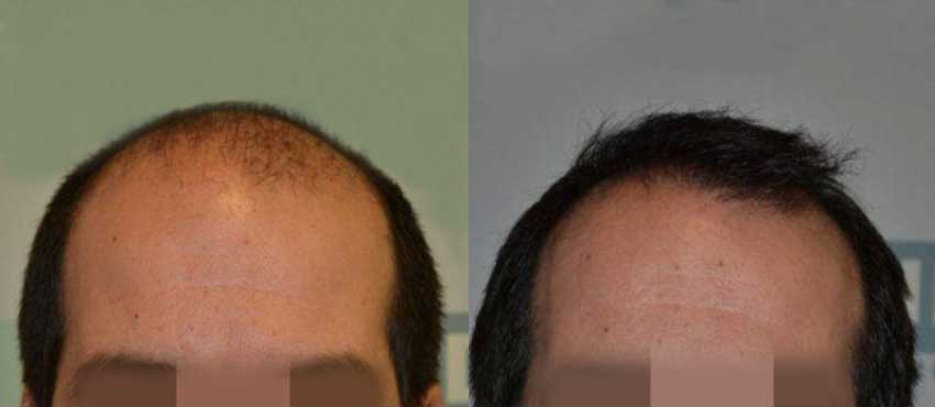 DHI before & after hair transplant results