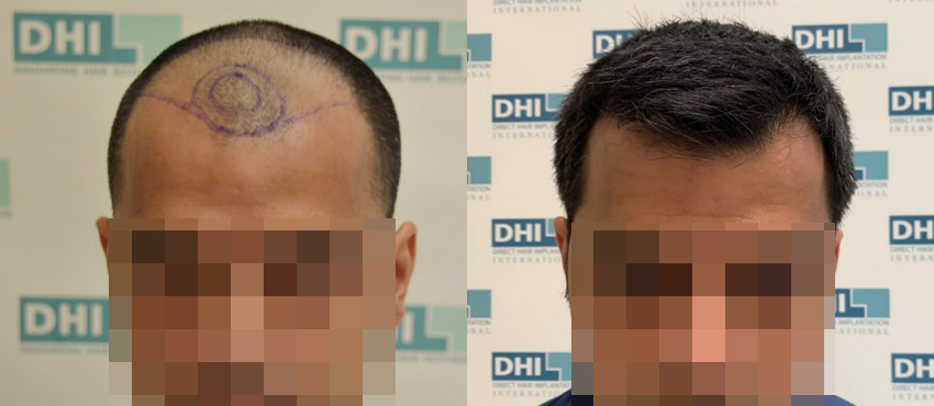 DHI before & after hair transplant results