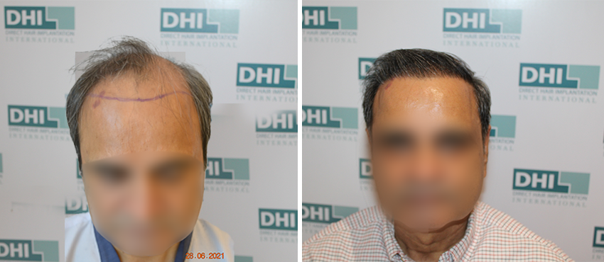 DHI before & after hair transplant results