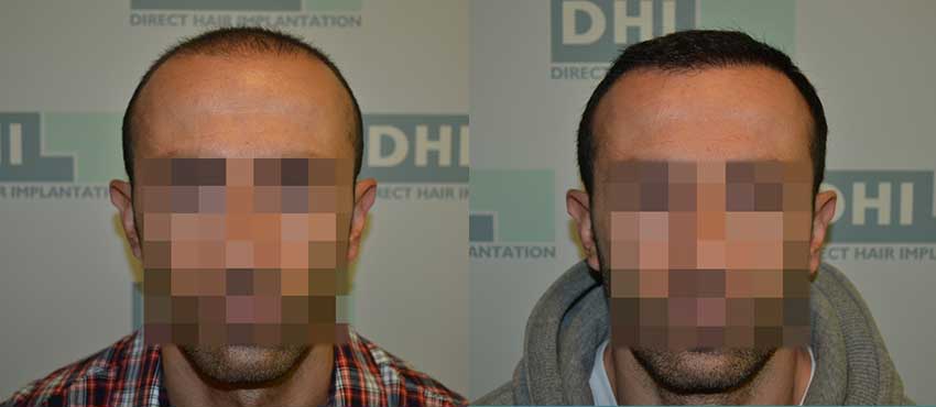 DHI before & after hair transplant results