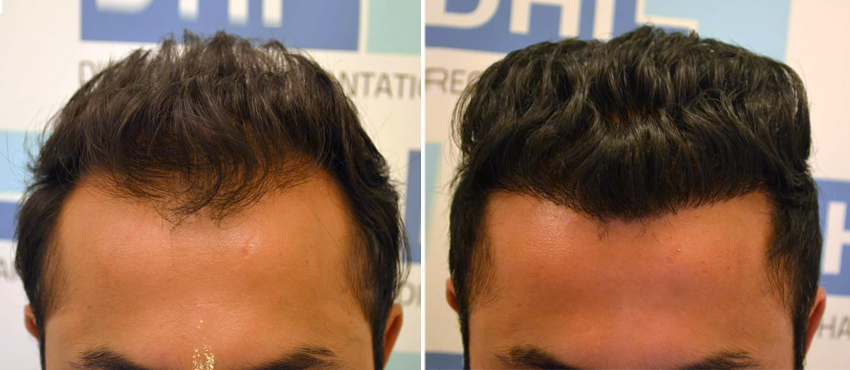 DHI before & after hair transplant results