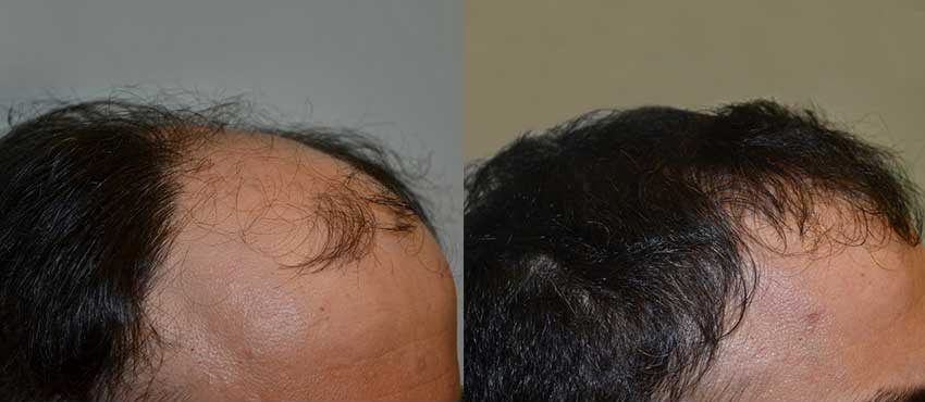 DHI before & after hair transplant results