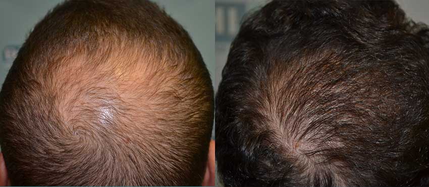 DHI before & after hair transplant results