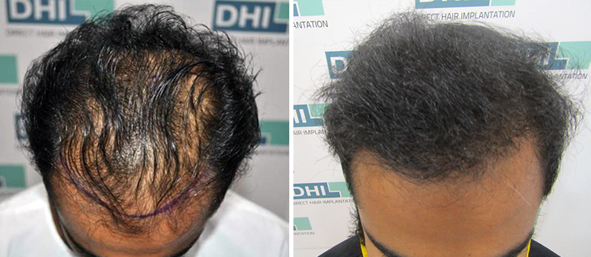 DHI before & after hair transplant results