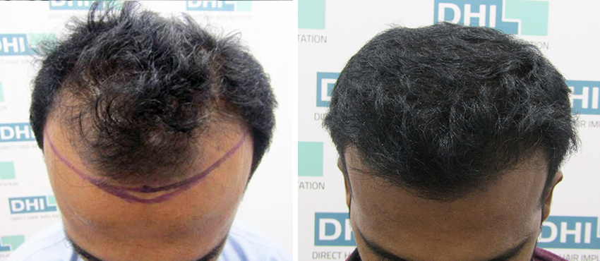 DHI before & after hair transplant results