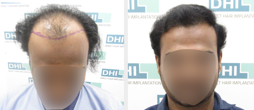 DHI before & after hair transplant results