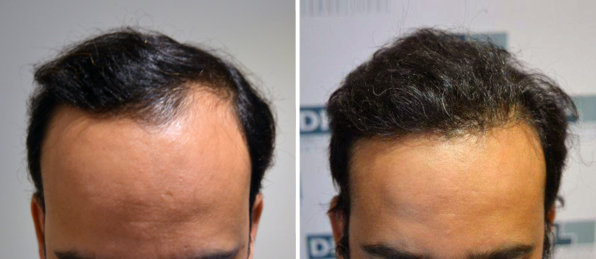 DHI before & after hair transplant results