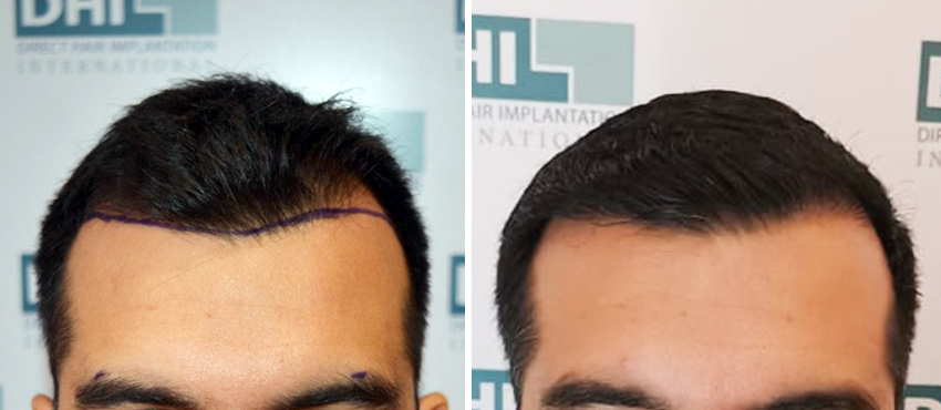 DHI before & after hair transplant results