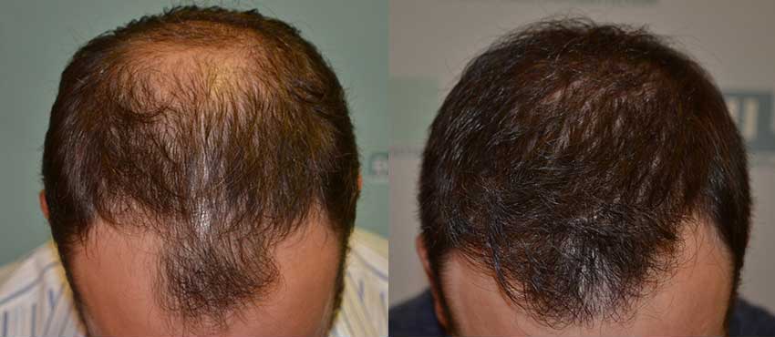 DHI before & after hair transplant results