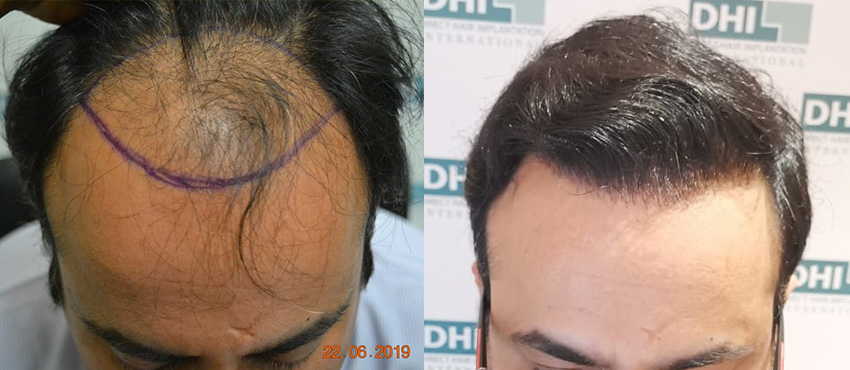 DHI before & after hair transplant results