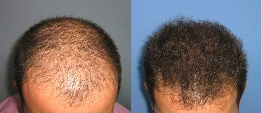 DHI before & after hair transplant results