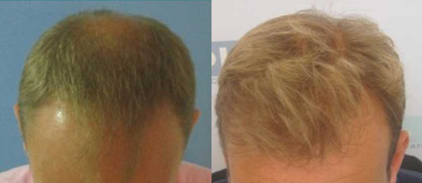 DHI before & after hair transplant results