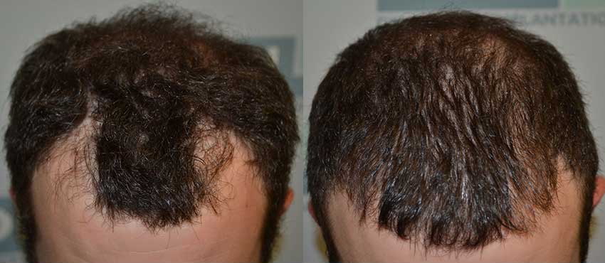 DHI before & after hair transplant results