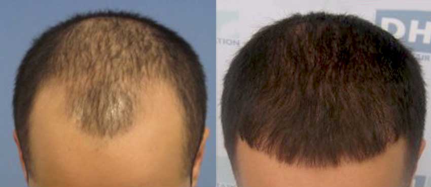 DHI before & after hair transplant results