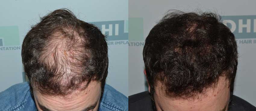 DHI before & after hair transplant results