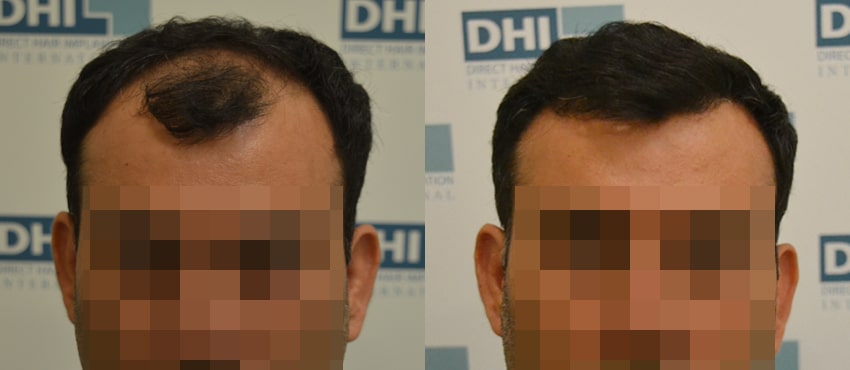 DHI before & after hair transplant results