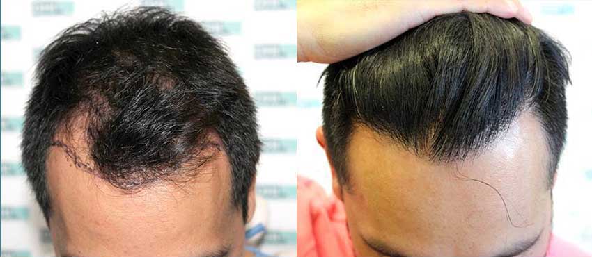 DHI before & after hair transplant results