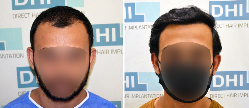 DHI before & after hair transplant results