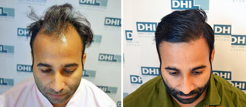 DHI before & after hair transplant results