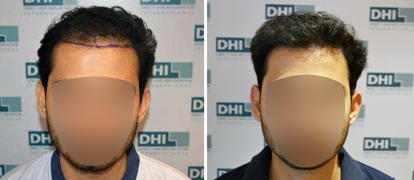 DHI before & after hair transplant results