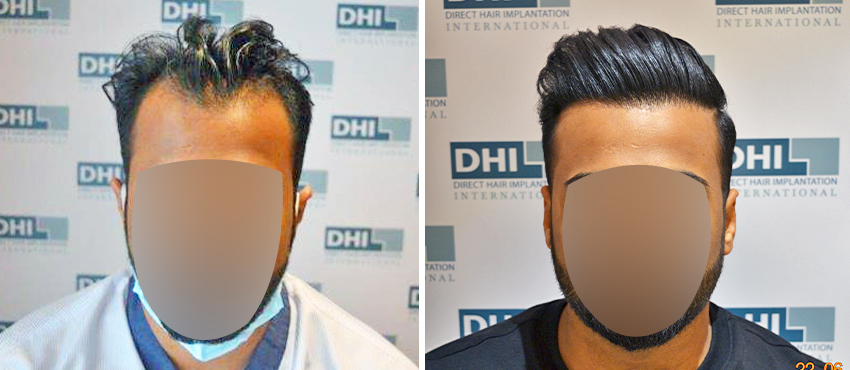 DHI before & after hair transplant results