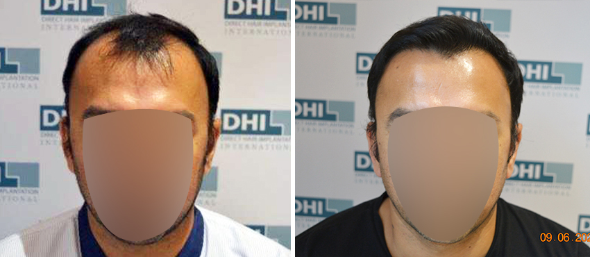 DHI before & after hair transplant results