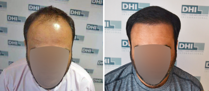 DHI before & after hair transplant results