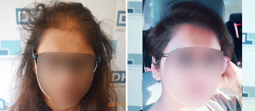 DHI before & after hair transplant results