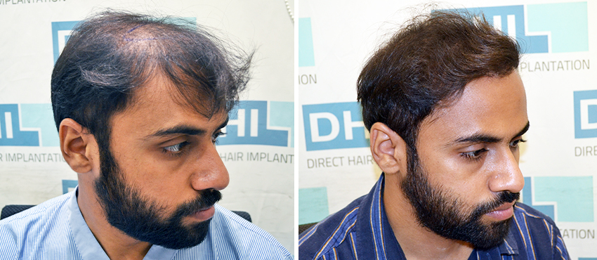 DHI before & after hair transplant results