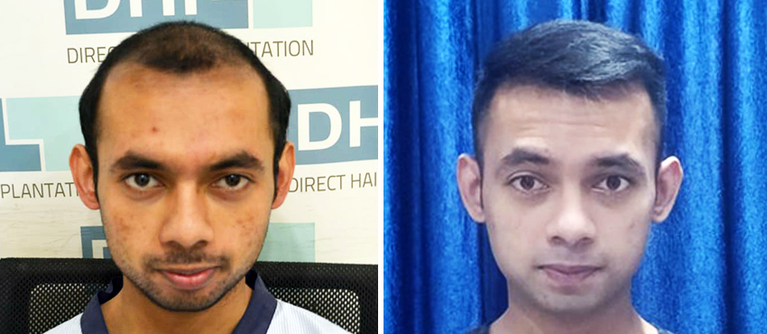 DHI before & after hair transplant results