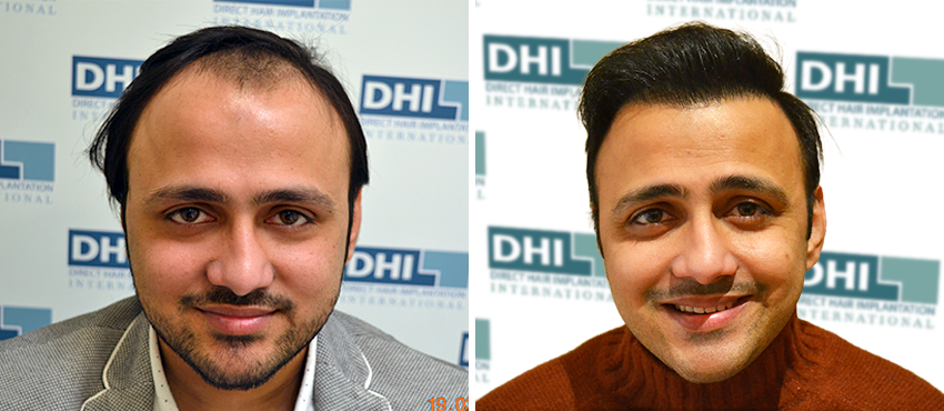 DHI before & after hair transplant results