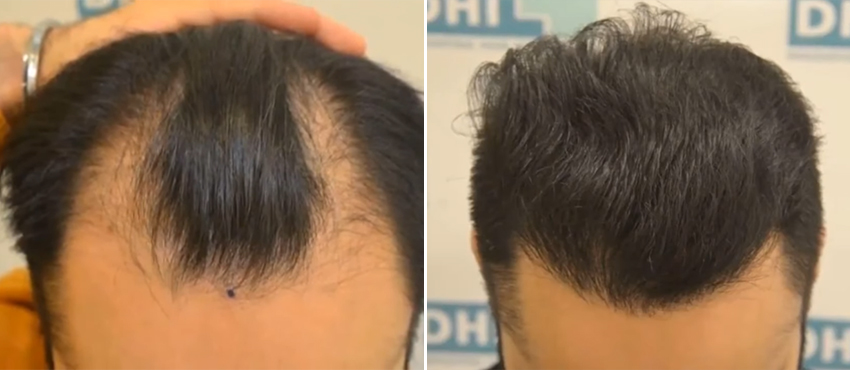 DHI before & after hair transplant results