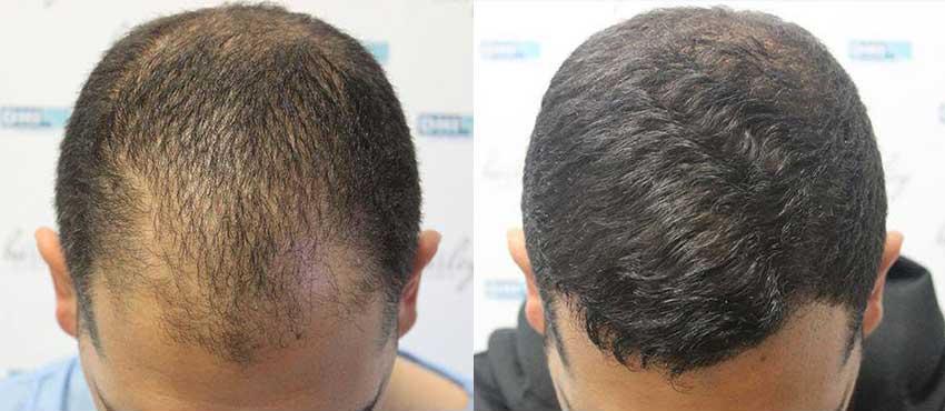 DHI before & after hair transplant results