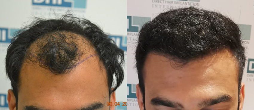 DHI before & after hair transplant results