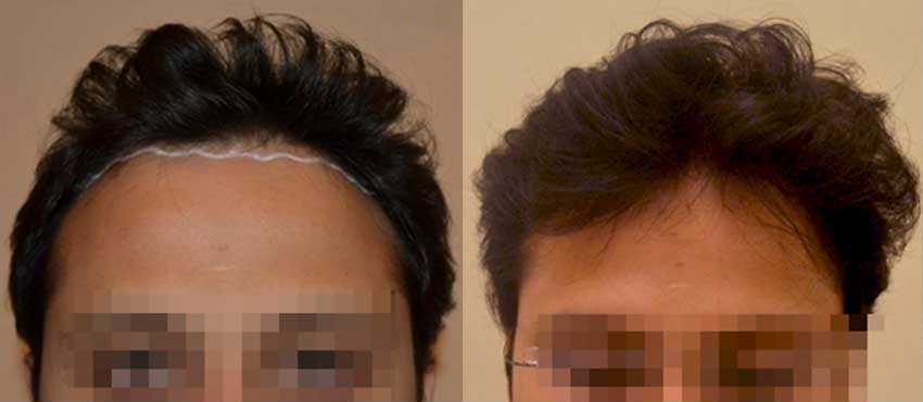 DHI before & after hair transplant results