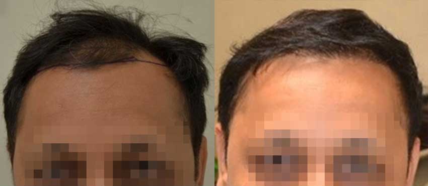 DHI before & after hair transplant results