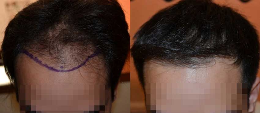 DHI before & after hair transplant results