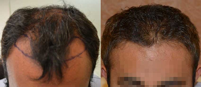 DHI before & after hair transplant results