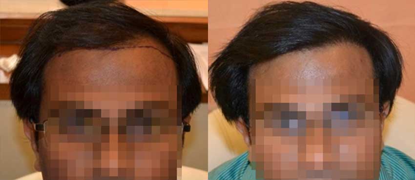 DHI before & after hair transplant results