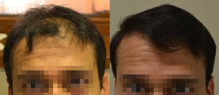 DHI before & after hair transplant results