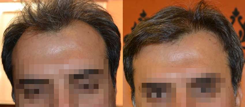 DHI before & after hair transplant results