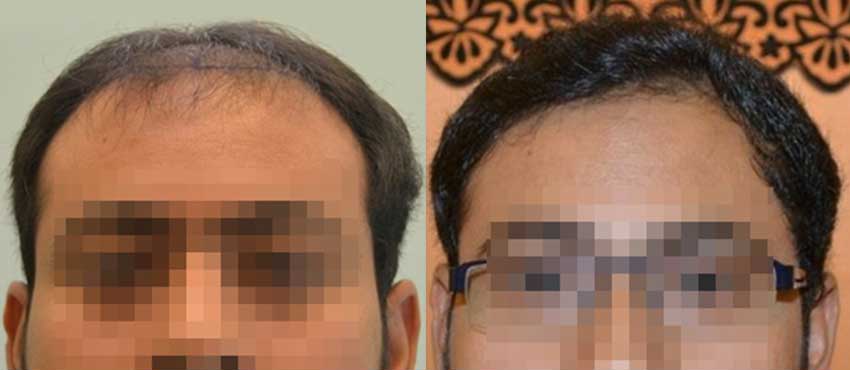 DHI before & after hair transplant results